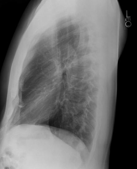 rentgenska slika prsnog koša