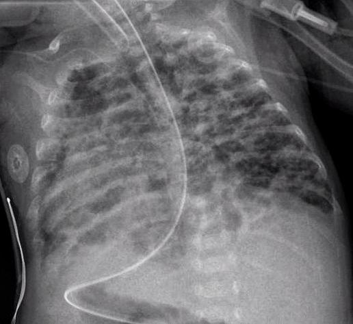 Закључак рендгенског снимка груди