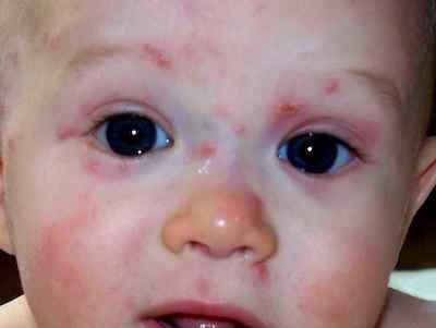 varicella in bambini sotto un anno