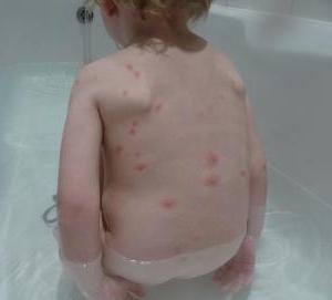 primi segni di varicella nei bambini