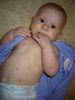kuřecí neštovice u dětí