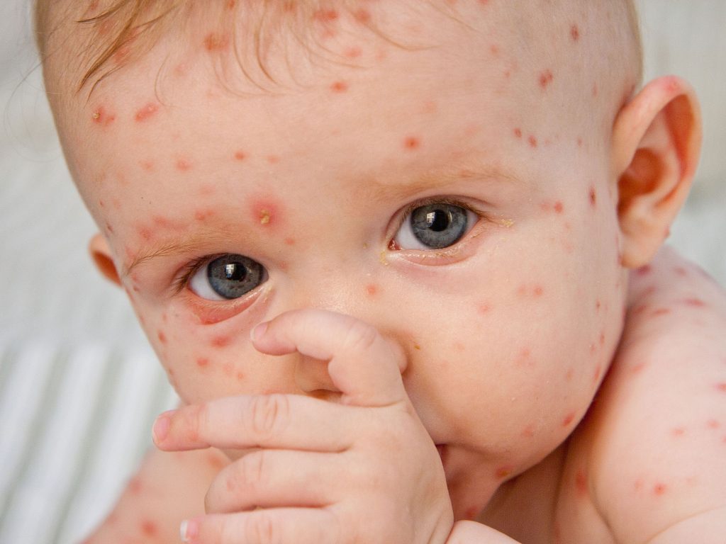 sintomi di varicella nei neonati
