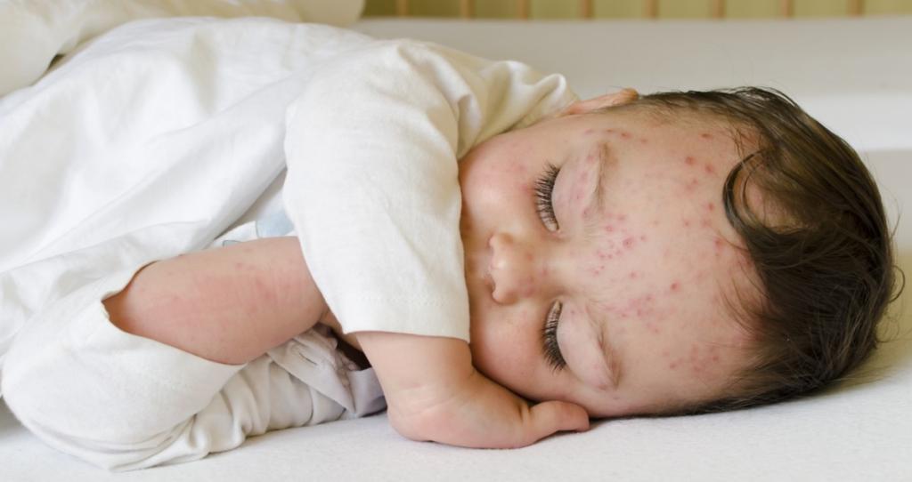 varicella nel trattamento dei bambini