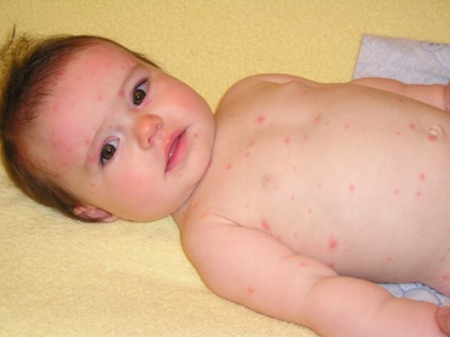 варицела при бебета симптоми и лечение