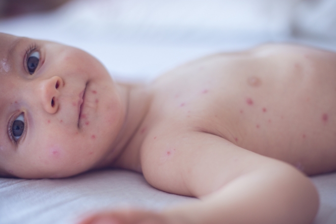 i bambini soffrono di varicella
