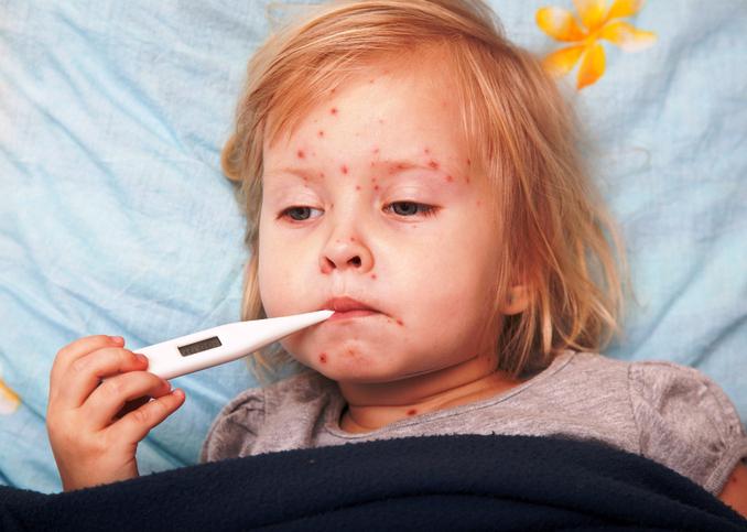 kuřecí neštovice u dětí