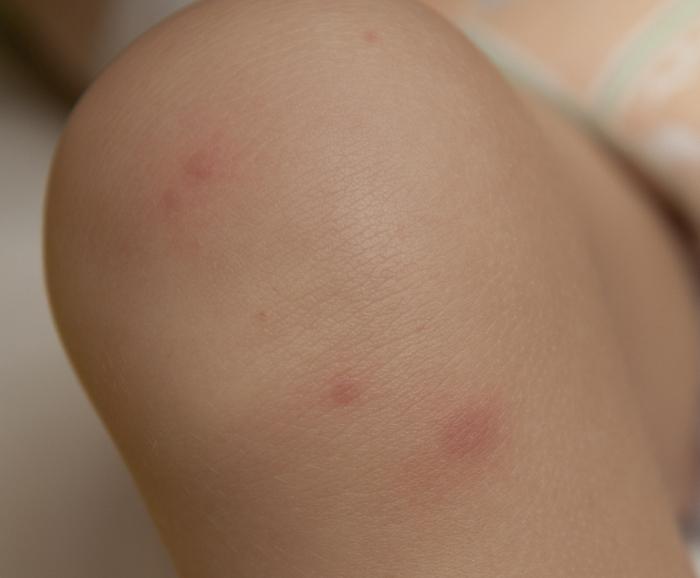 příznaky a léčba neštovic