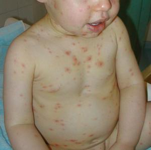 kuřecí neštovice v léčbě dětí