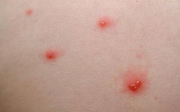 come si manifesta la varicella nei bambini