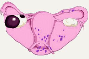 objawy przewlekłego endometrium
