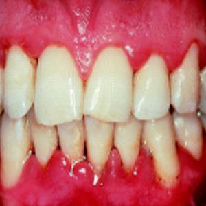 ošetření parodontitidy