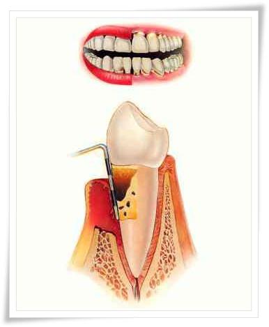 kroničnega zdravljenja parodontitisa
