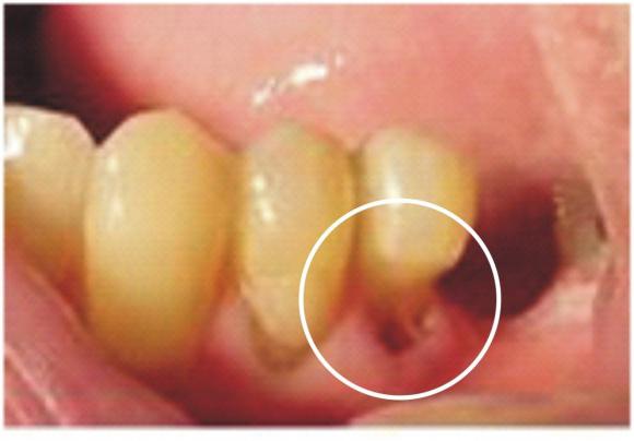 antibiotická léčba parodontitidy