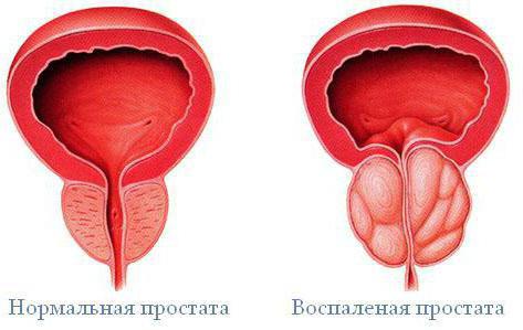 sintomi prostata ingrossata e infiammata tincturi împotriva prostatitei