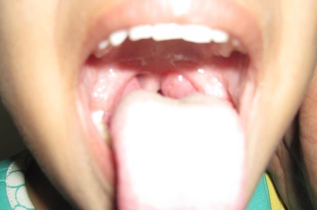 trattamento della tonsillite cronica
