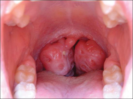 trattamento della tonsillite cronica con antibiotici,