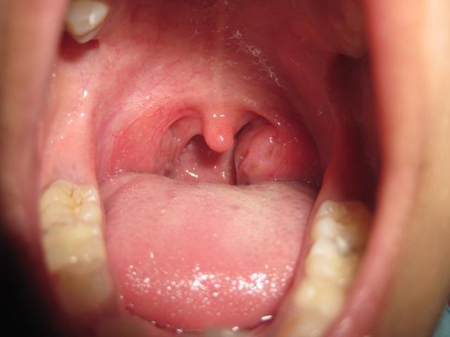 tonsillite cronica nei bambini