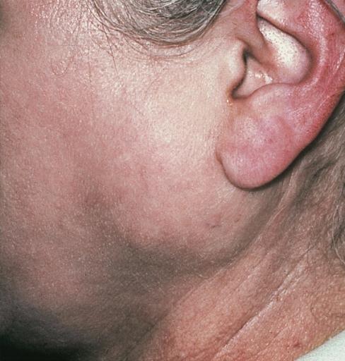 infiammazione delle ghiandole salivari