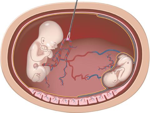 koagulogram podczas ciąży