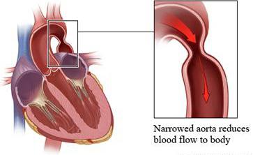 diagnozo aortne koarktacije