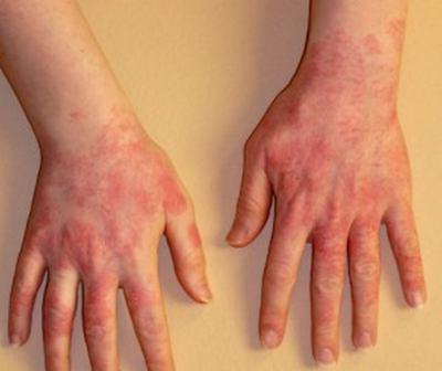 příčin studených alergií