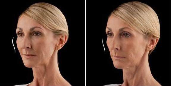 Recensioni extra facciali al collagene