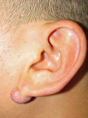Koloidní jizva na uchu