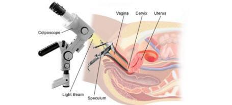 Com'è la colposcopia della cervice e della vagina