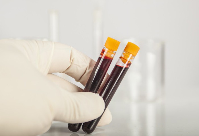 промени в общия кръвен тест за HIV
