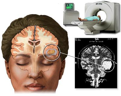 možganska tomografija