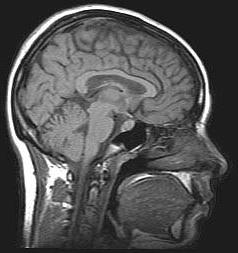 компютърна томография на мозъка