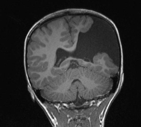 rezonans magnetyczny mózgu