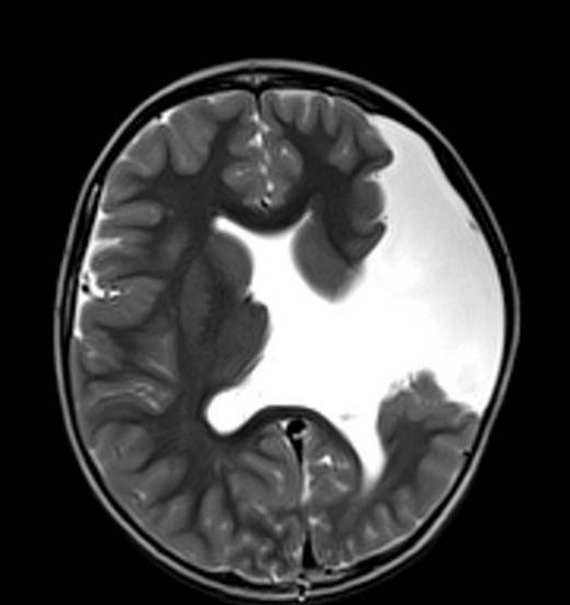 магнитна томография на мозъка