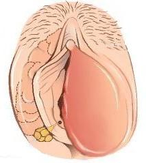 míč na pohlavních orgánech