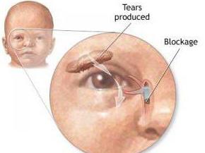 konjunktivitis kod novorođenčadi