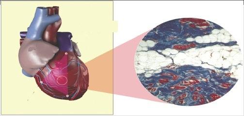 displazija vezivnega tkiva srca