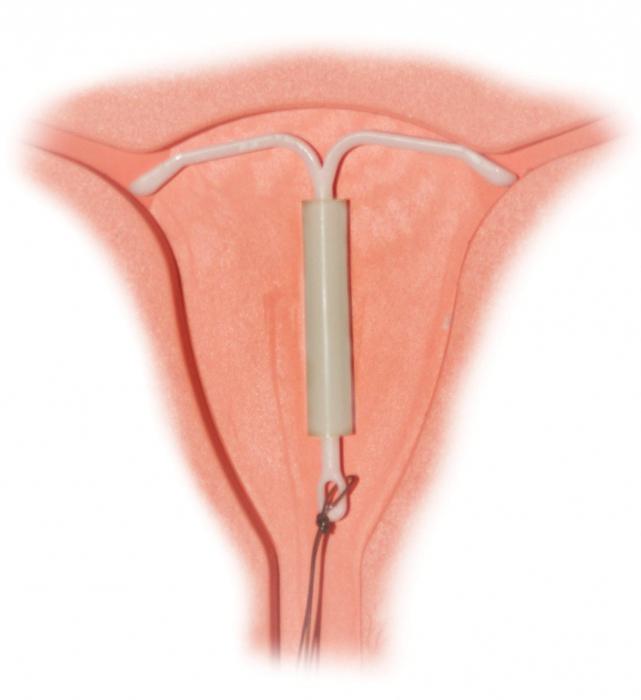 снимка на контрацептивна бобина