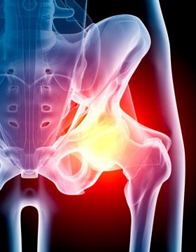 simptomi artroze kuka i liječenje savjetujte mast za bolove u zglobovima koljena