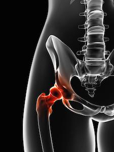 come trattare la coxartrosi dell'articolazione dell'anca