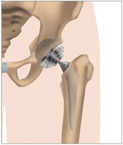sintomi della coxartrosi dell'articolazione dell'anca