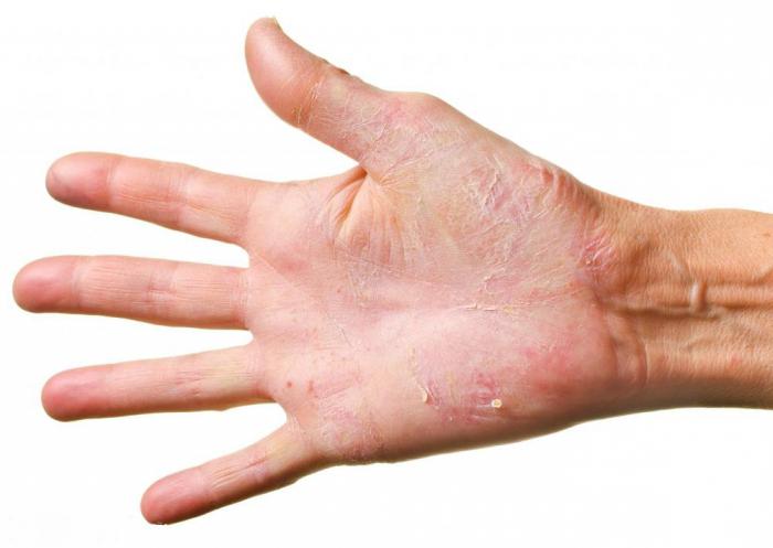 Cracked kůže na ruce