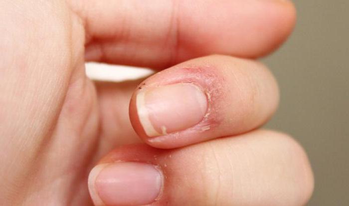 Napuknuta koža na prstima oko noktiju