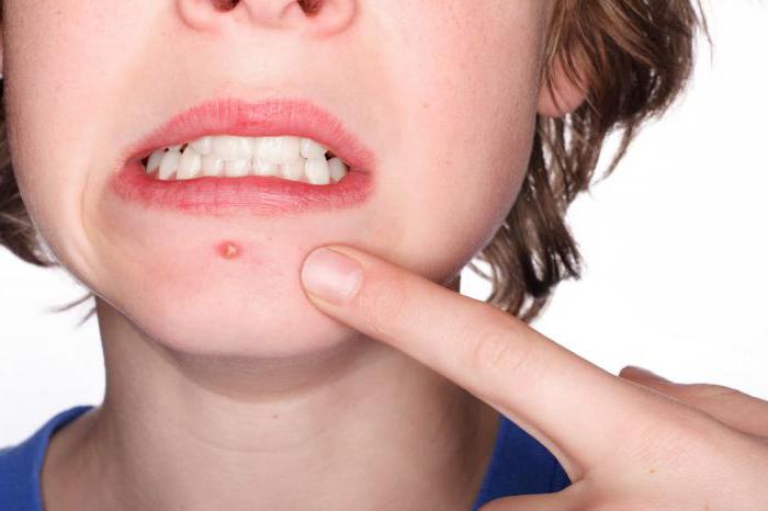 recensioni di acne derm dell'acx