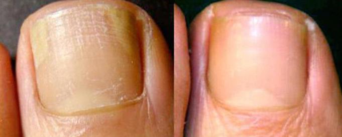фундазол от ноктите гъбички преди и след
