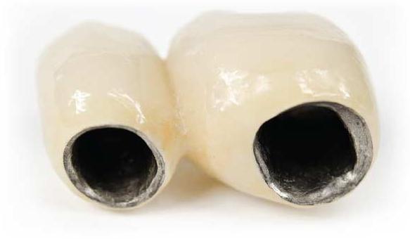 кои корони са по-добре да се поставят върху дъвчещи зъби
