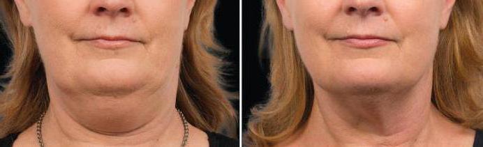 цриолиполисис брада пре и после фото прегледа