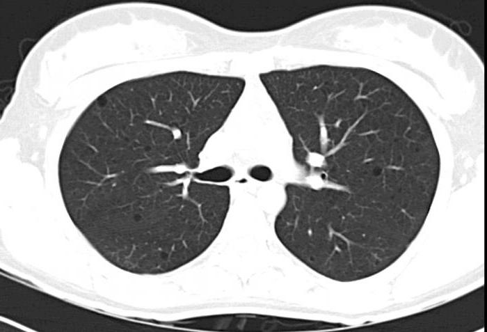 CT płuc