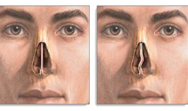 curvatura del setto nasale