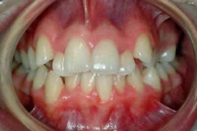křivé zuby