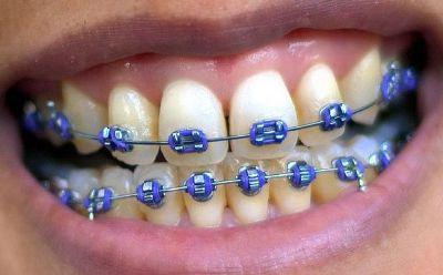 liječenje iskrivljenih zubi